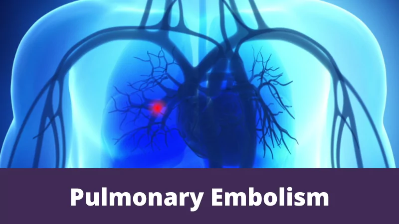 Pulmonary Embolism