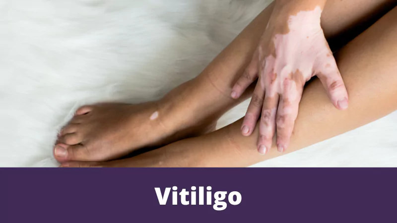 Vitiligo